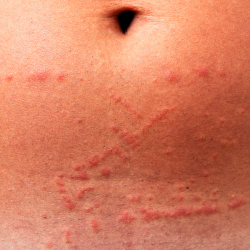 a close up of a person 's stomach with jellyfish sting