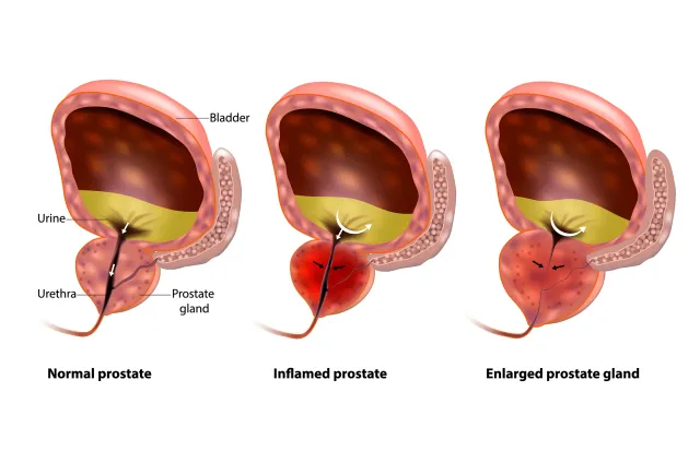 Enlarged Prostate Treatment in Nashville & Murfreesboro| Prostate Artery Embolization (PAE)