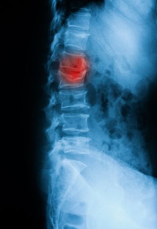 Vertebral Compression Fractures  Murfreesboro Vascular and Interventional