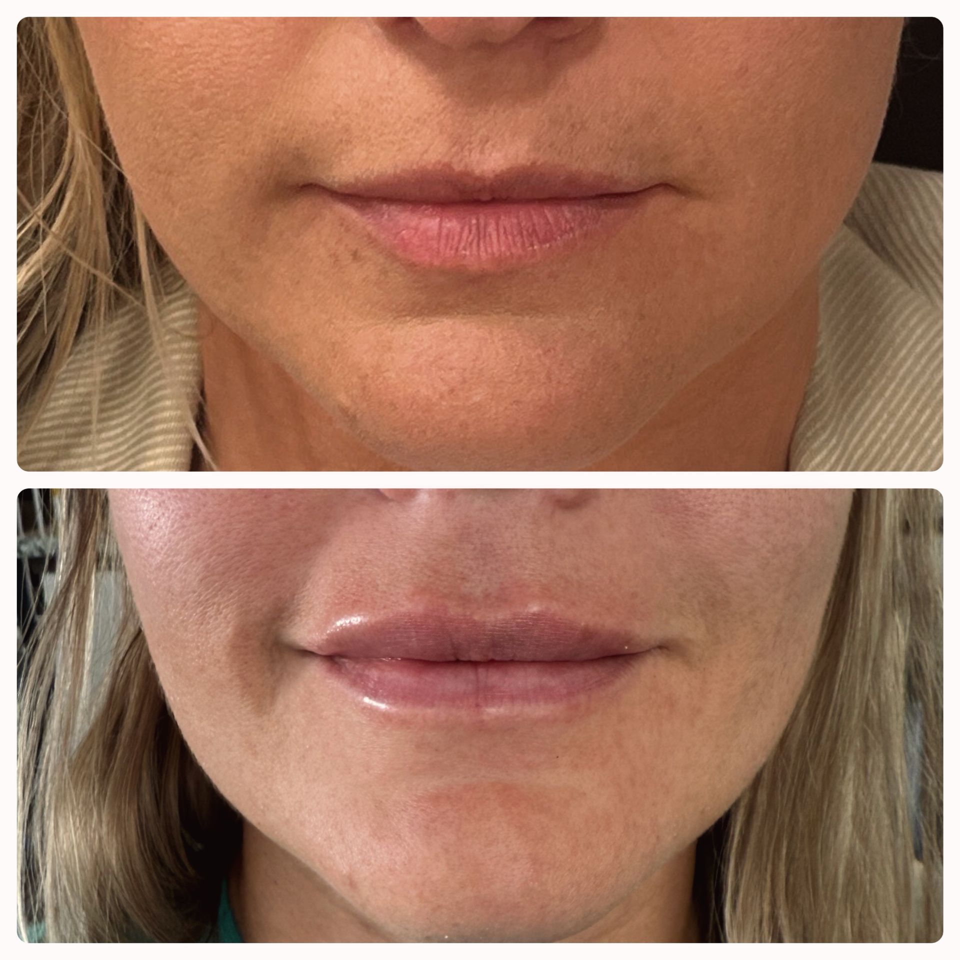 A before and after photo of a woman 's lips.