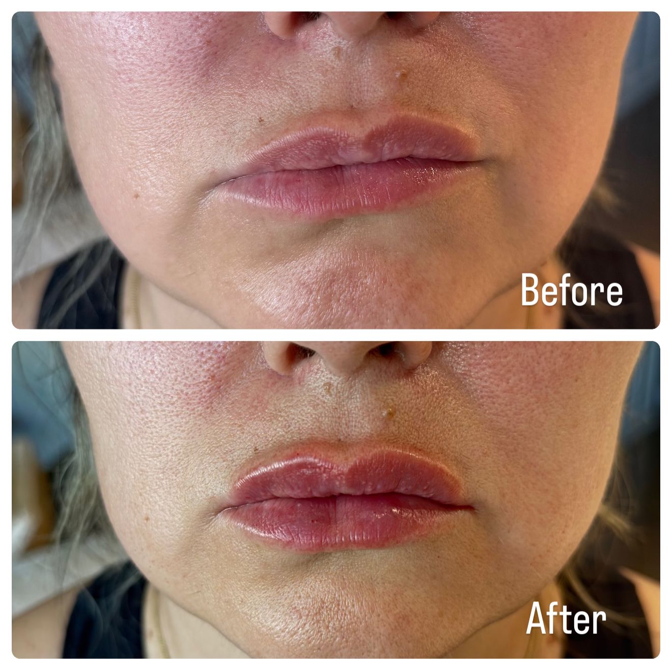 A before and after picture of a woman 's lips.