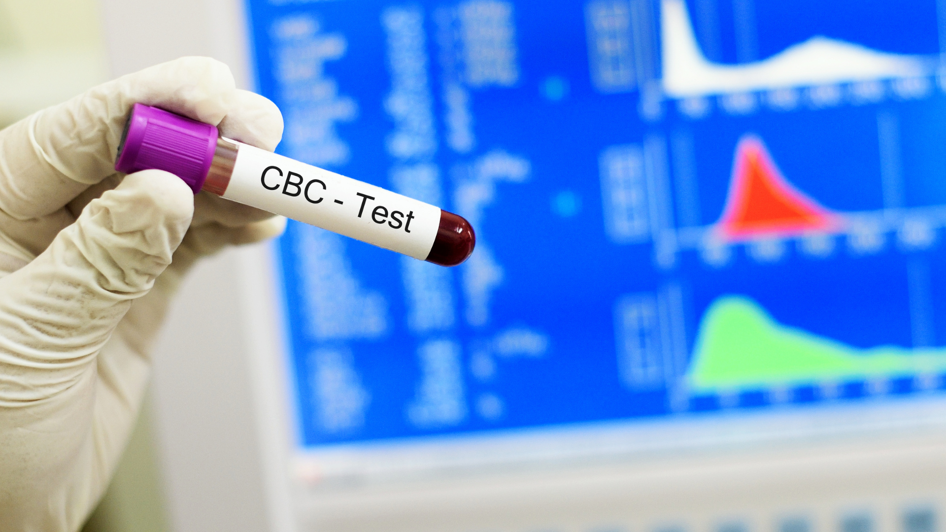 A clinic staff holds up a vial from a CBC blood work panel.