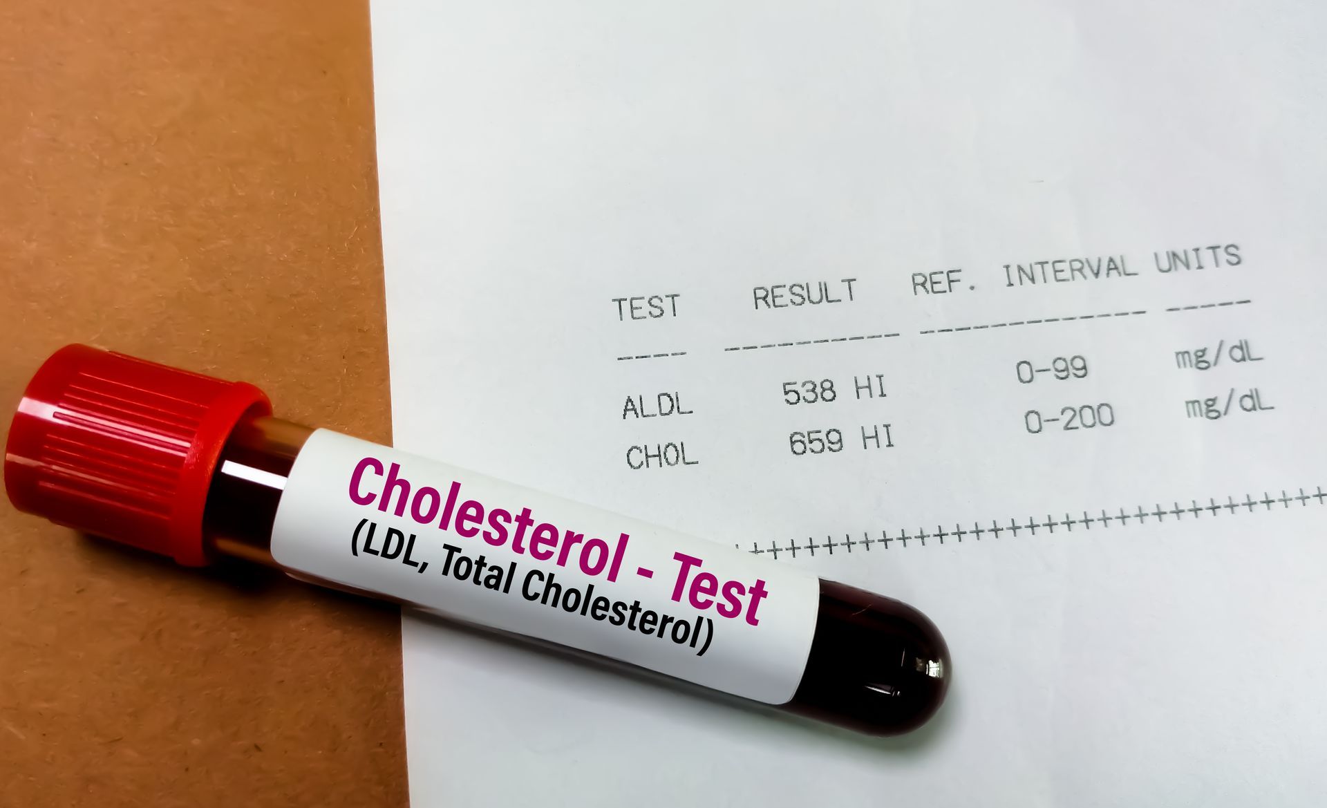 Blood sample labeled for a lipid panel with lab report showing high LDL and total cholesterol.