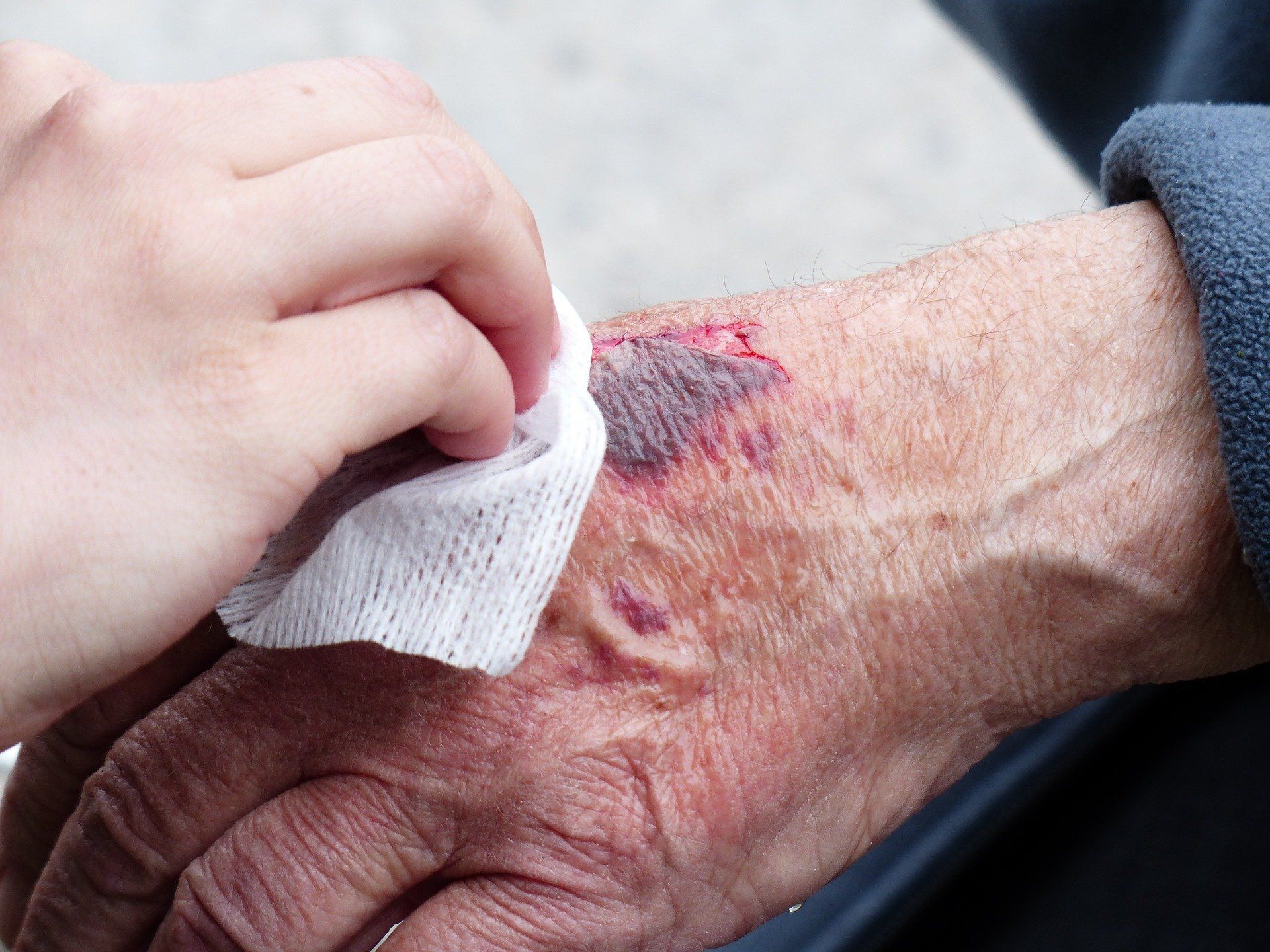 Best Tips for Wound Care for Seniors