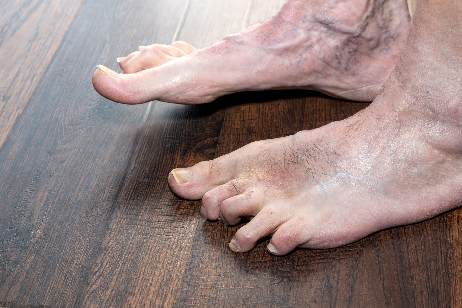 Close-up of bare feet on a wood floor, showing prominent veins and toes, possibly indicating a health issue.