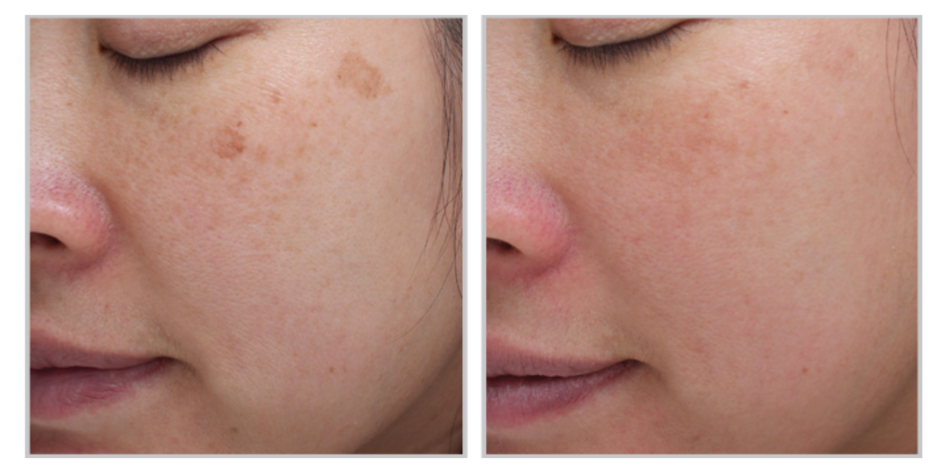 A Before And After Photo Of A Woman's Face With Spots On It — Aura Mediclinic In Ashmore, QLD