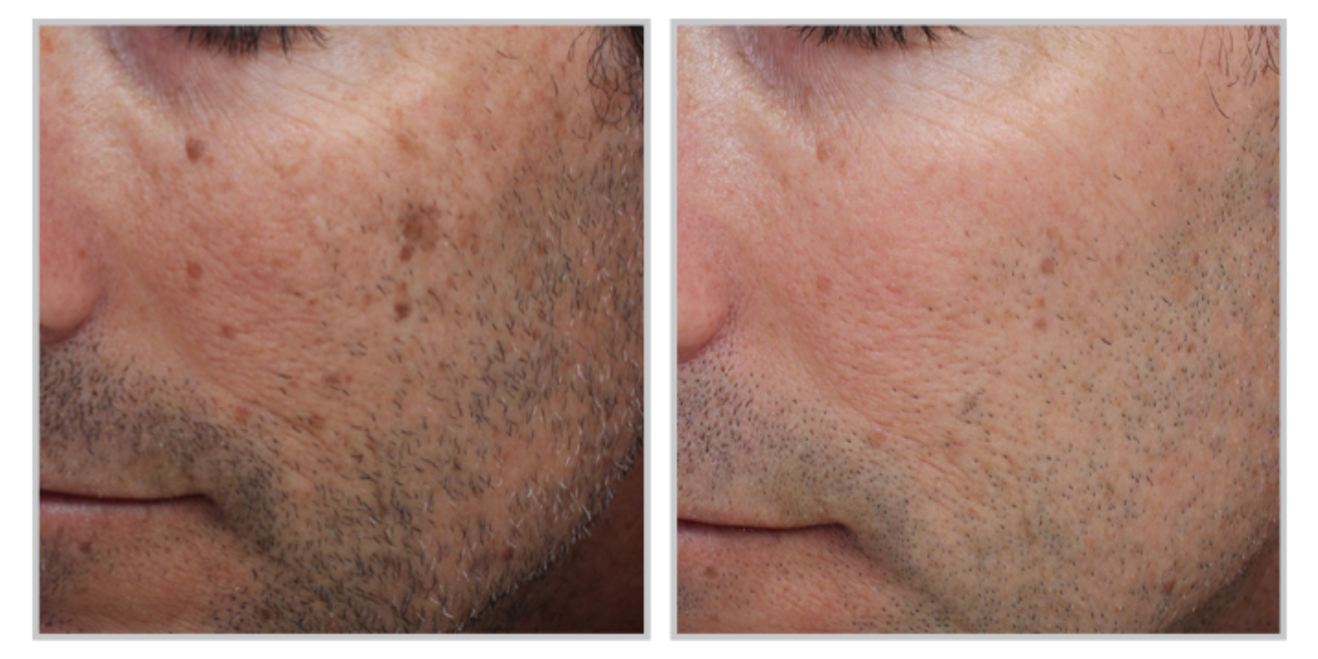 A Before And After Photo Of A Man's Face With A Beard — Aura Mediclinic In Ashmore, QLD