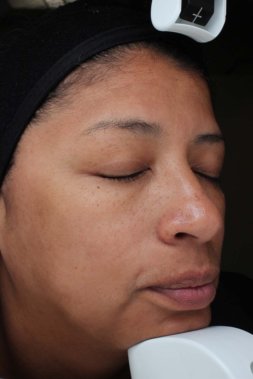 A Close Up Of A Woman's Face With Her Eyes Closed — Aura Mediclinic In Ashmore, QLD