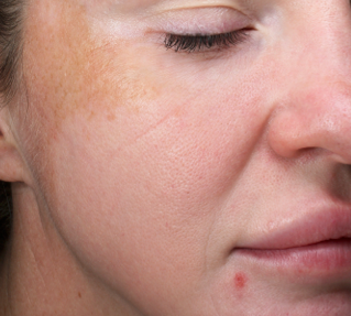 A Close Up Of A Woman's Face With Her Eyes Closed — Aura Mediclinic In Ashmore, QLD