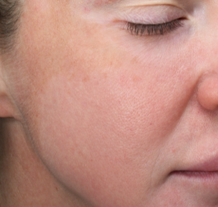 A Close Up Of A Woman's Face With Her Eyes Closed — Aura Mediclinic In Ashmore, QLD