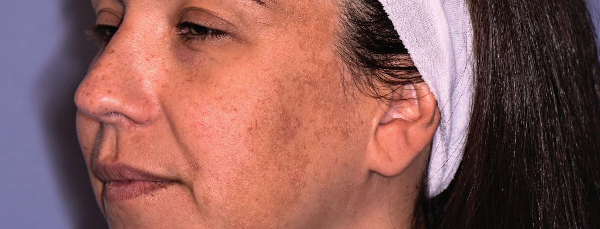 A Close Up Of A Woman's Face With A Towel Around Her Head — Aura Mediclinic In Ashmore, QLD