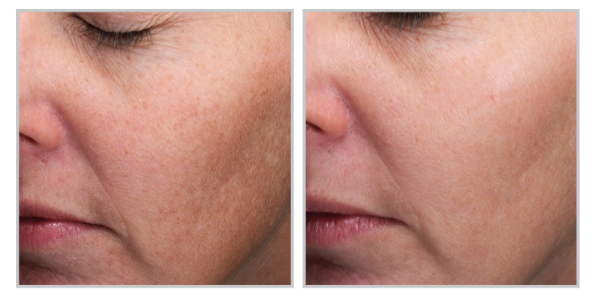 A Before And After Photo Of A Woman's Face— Aura Mediclinic In Ashmore, QLD