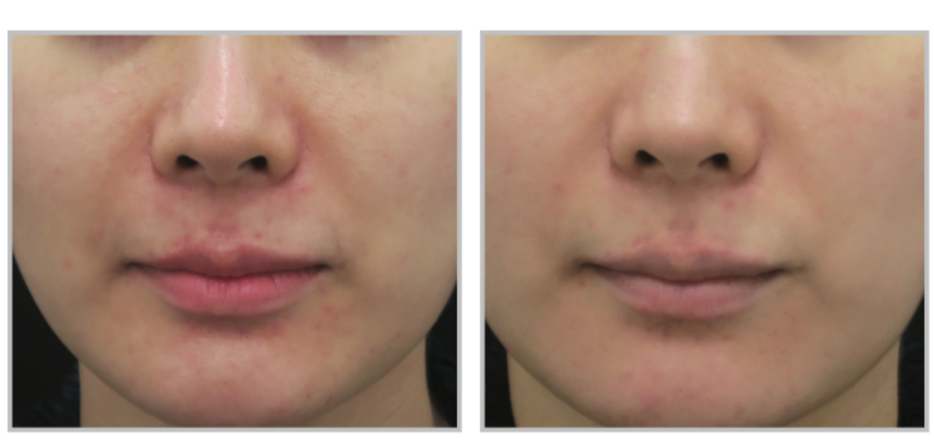 A Before And After Photo Of A Women's Face— Aura Mediclinic In Ashmore, QLD