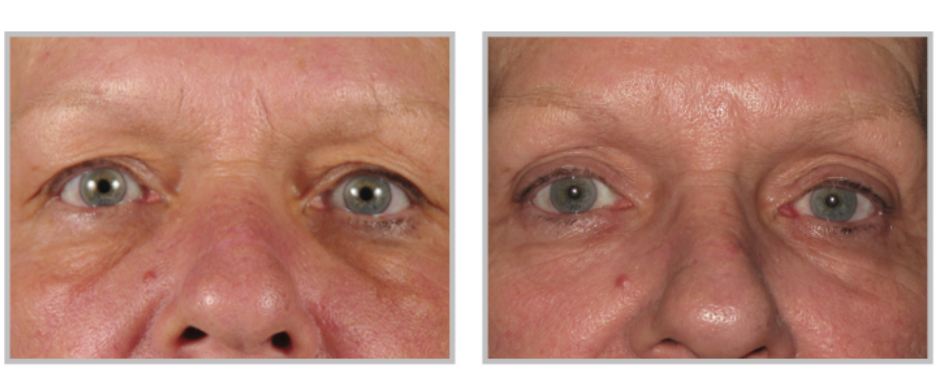 A Before And After Photo Of A Woman's Face— Aura Mediclinic In Ashmore, QLD