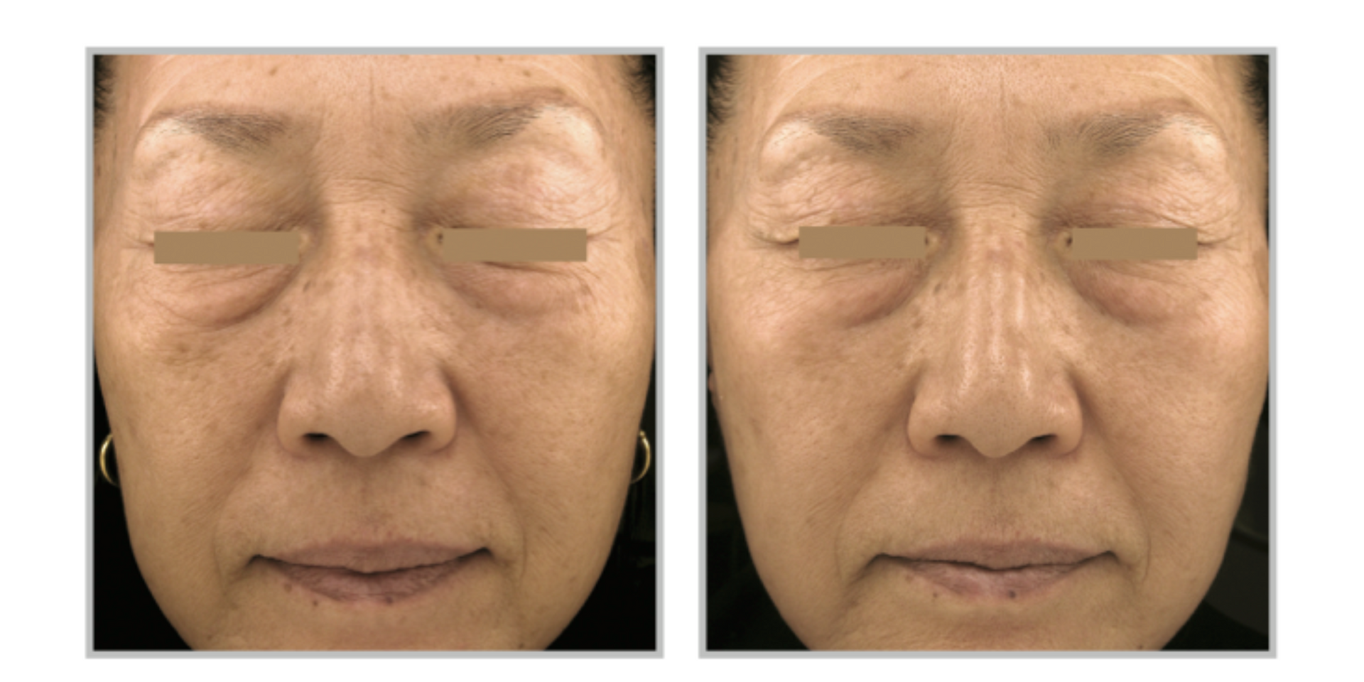 A Before And After Photo Of A Woman's Face With Spots On It — Aura Mediclinic In Ashmore, QLD