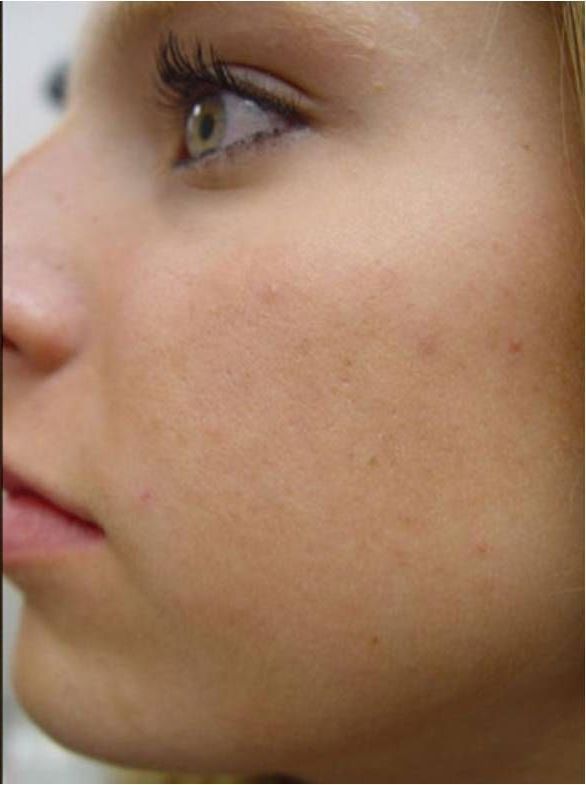 A Close Up Of A Women's Face With Her Eyes Open — Aura Mediclinic In Ashmore, QLD