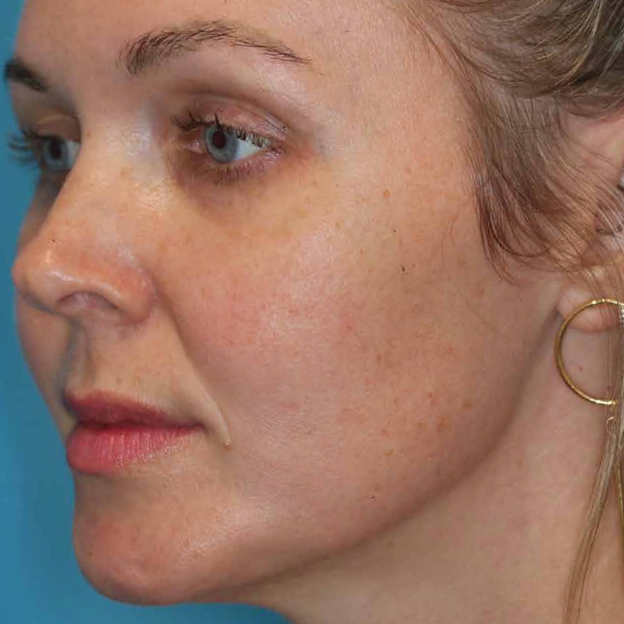 A Close Up Of A Woman's Face With Her Eyes Op — Aura Mediclinic In Ashmore, QLD