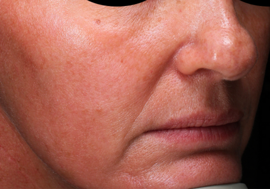 A Close Up Of A Woman's Face With A Towel Around Her Head — Aura Mediclinic In Ashmore, QLD