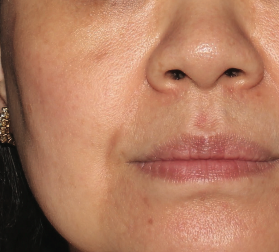 A Close Up Of A Woman's Face With A Towel Around Her Head — Aura Mediclinic In Ashmore, QLD