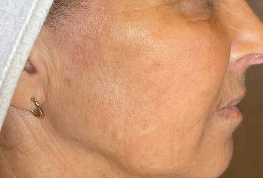 A Close Up Of A Woman's Face With A Towel Around Her Head — Aura Mediclinic In Ashmore, QLD