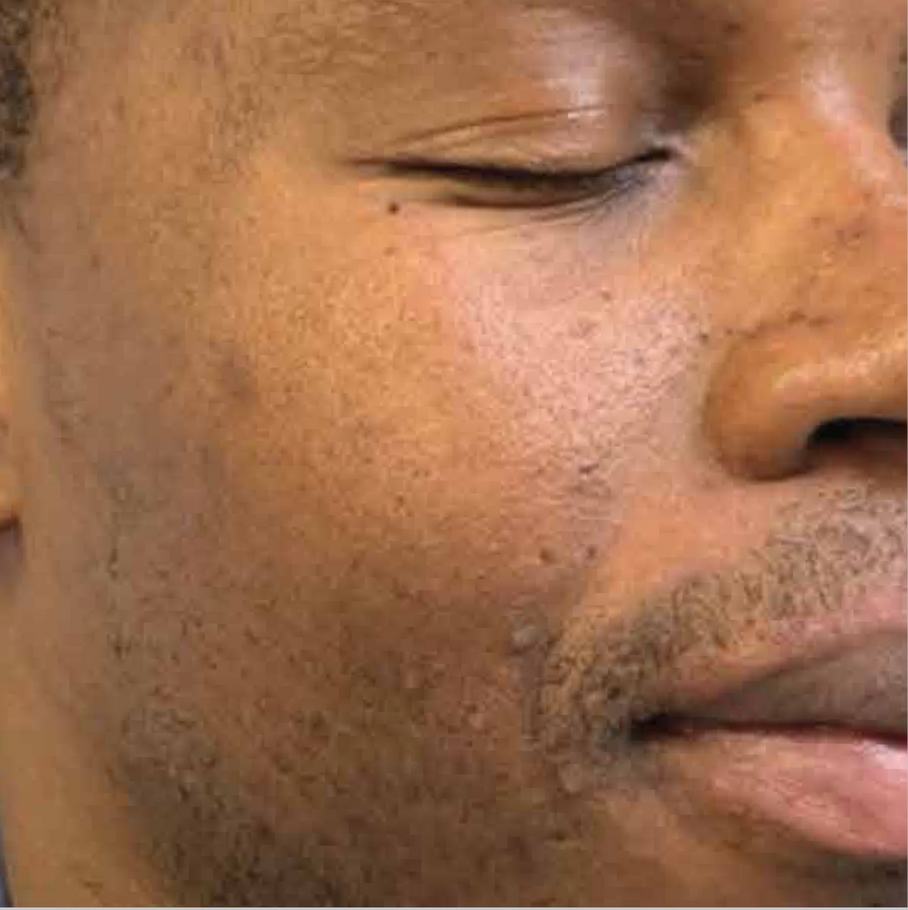 A Close Up Of A Man's Face With His Eyes Closed — Aura Mediclinic In Ashmore, QLD