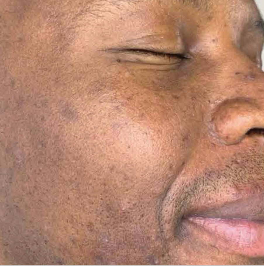 A Close Up Of A Man's Face With His Eyes Closed — Aura Mediclinic In Ashmore, QLD