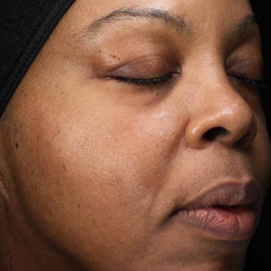 A Close Up Of A Woman's Face With A Towel Around Her Head — Aura Mediclinic In Ashmore, QLD