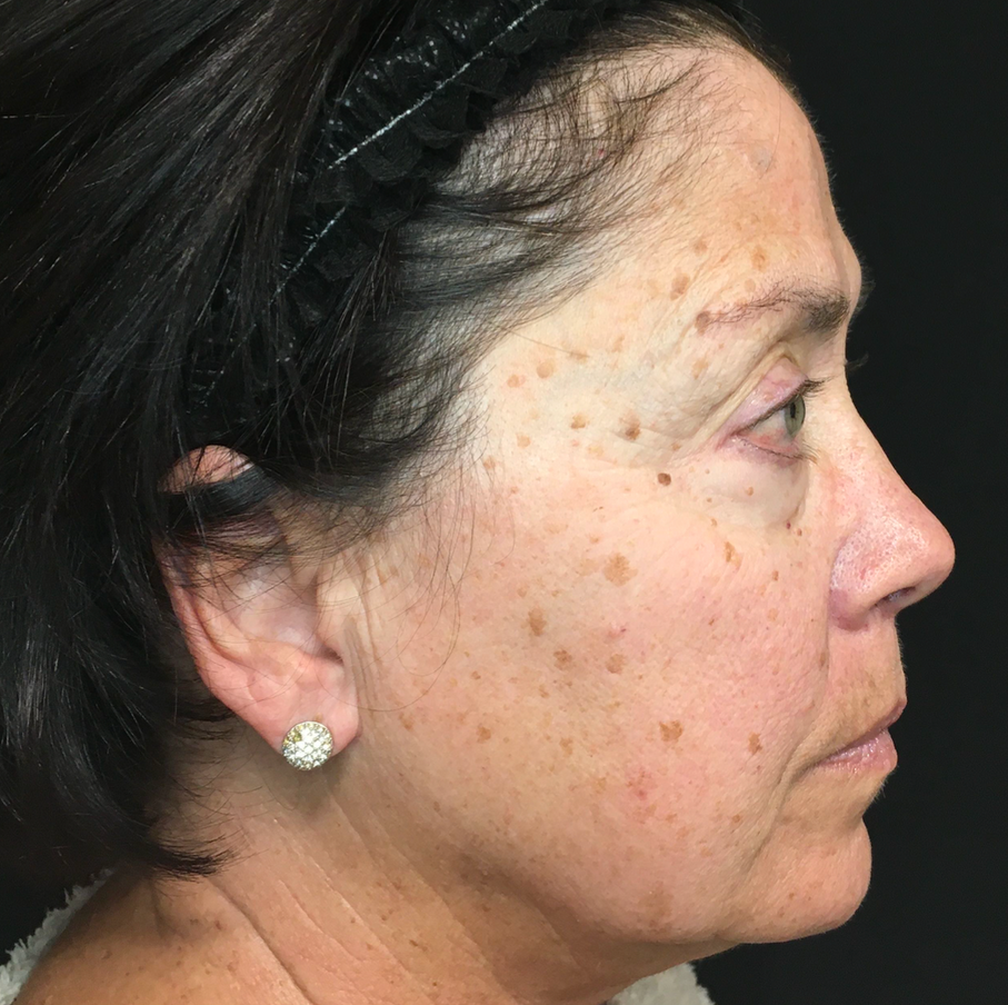 A Close Up Of A Woman's Face With A Towel Around Her Head — Aura Mediclinic In Ashmore, QLD