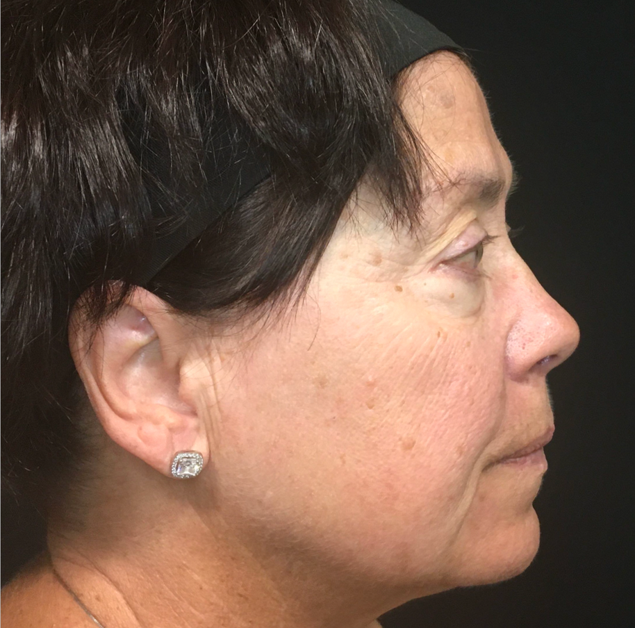 A Close Up Of A Woman's Face With Her Eyes Closed — Aura Mediclinic In Ashmore, QLD