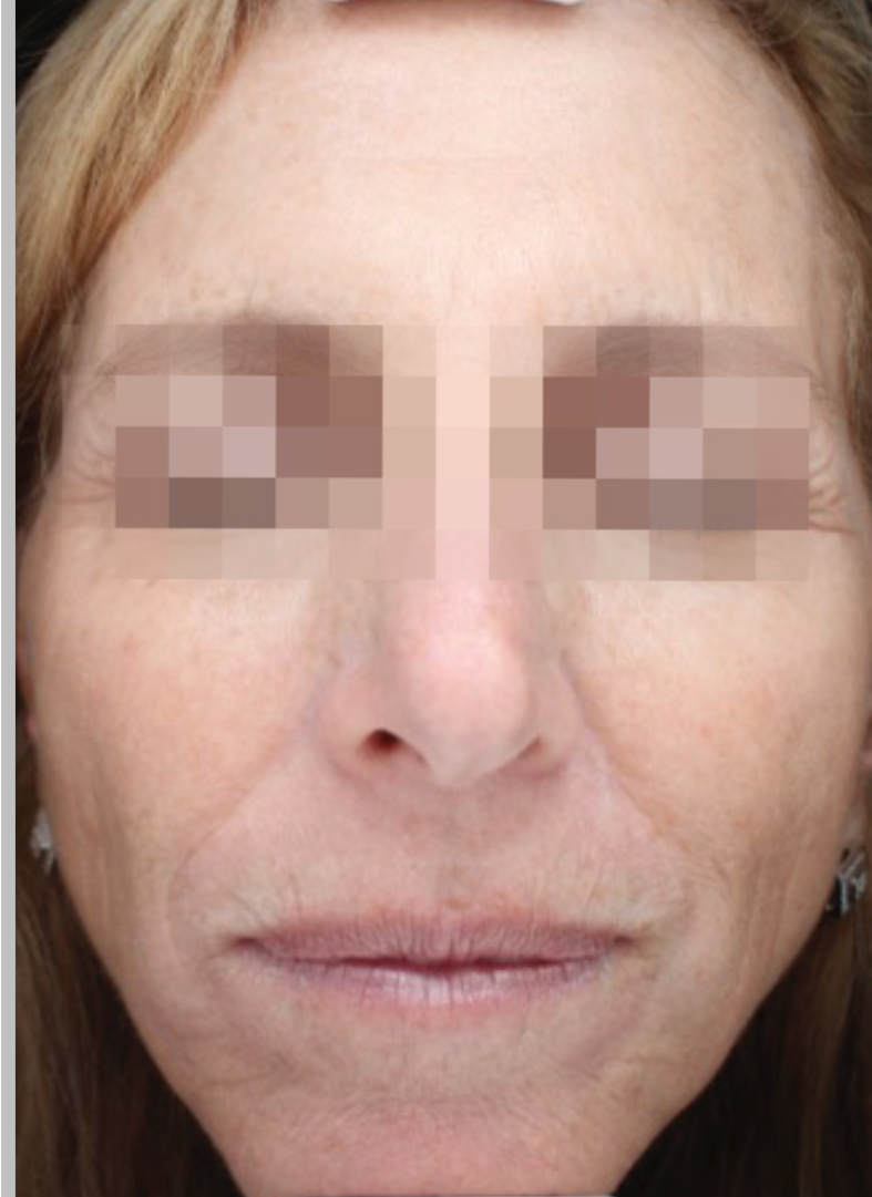 A Close Up Of A Woman's Face With A Towel Around Her Head — Aura Mediclinic In Ashmore, QLD