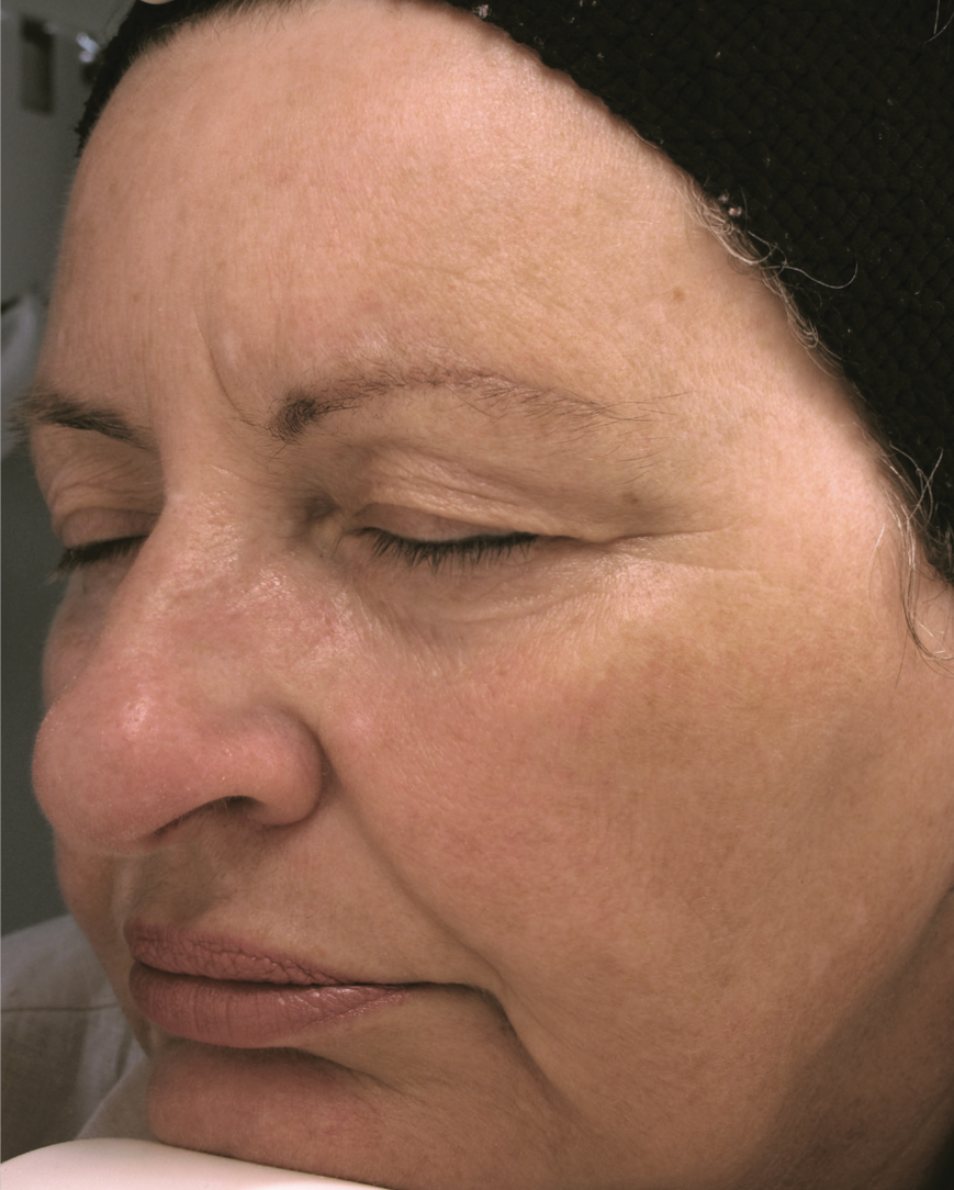 A Close Up Of A Woman's Face With A Towel Around Her Head — Aura Mediclinic In Ashmore, QLD