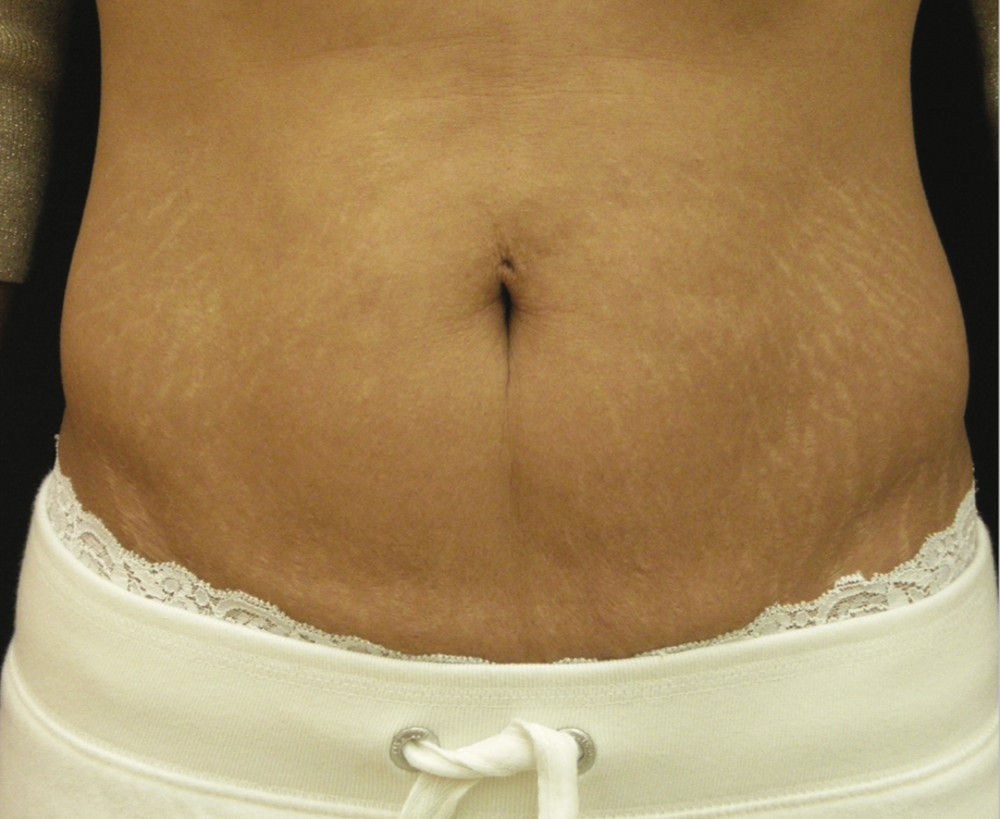 A Close Up Of A Woman's Face Abdoman  — Aura Mediclinic In Ashmore, QLD