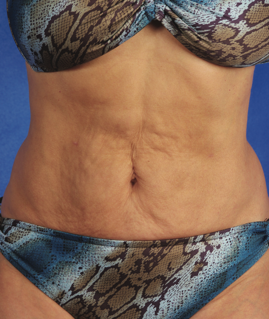 A Close Up Of A Woman's Abdomen   — Aura Mediclinic In Ashmore, QLD