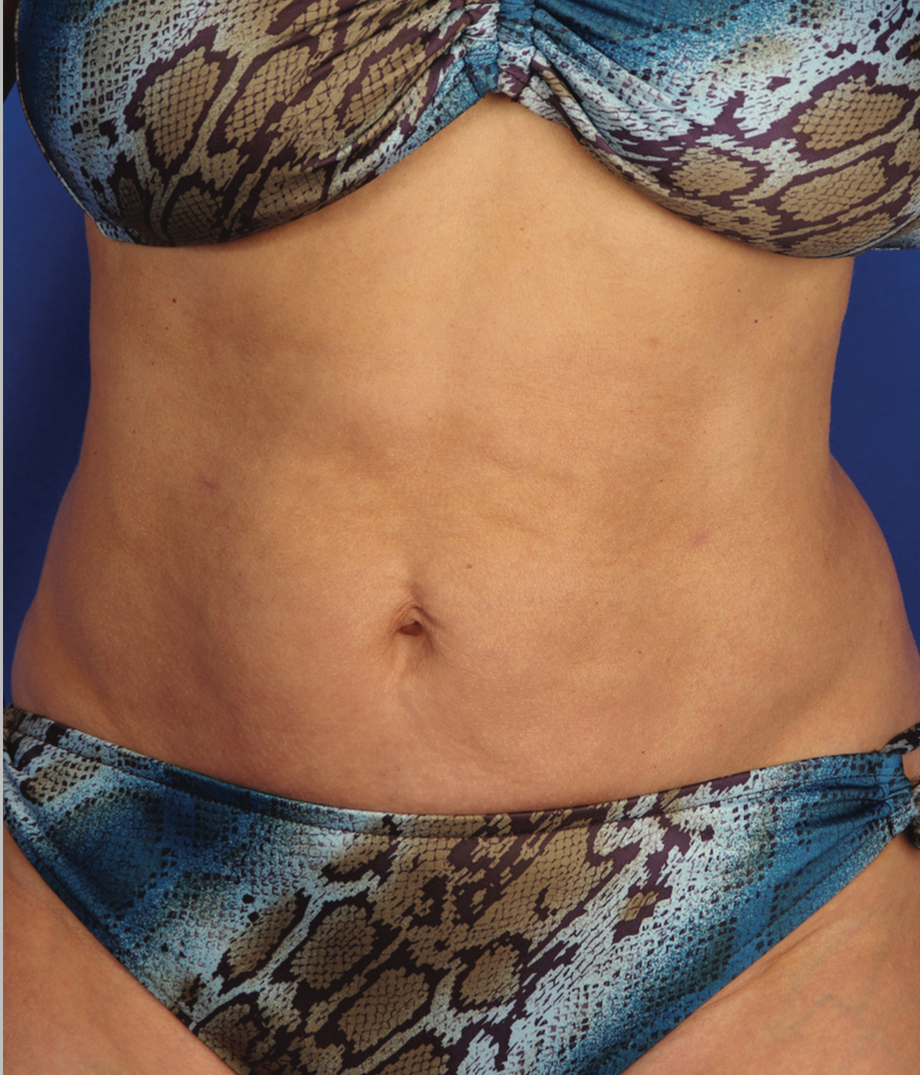 A Close Up Of A Woman's Abdomen  — Aura Mediclinic In Ashmore, QLD