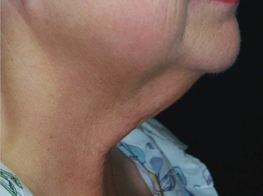 A Close Up Of A Women's Face At Side Profile — Aura Mediclinic In Ashmore, QLD