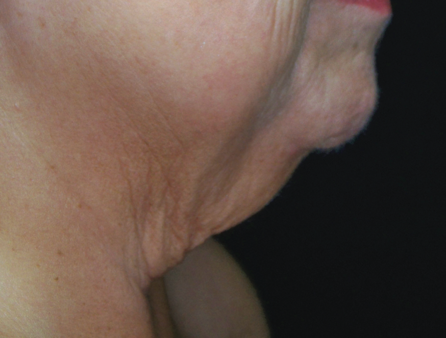 A Close Up Of A Women's Face At Side Profile — Aura Mediclinic In Ashmore, QLD