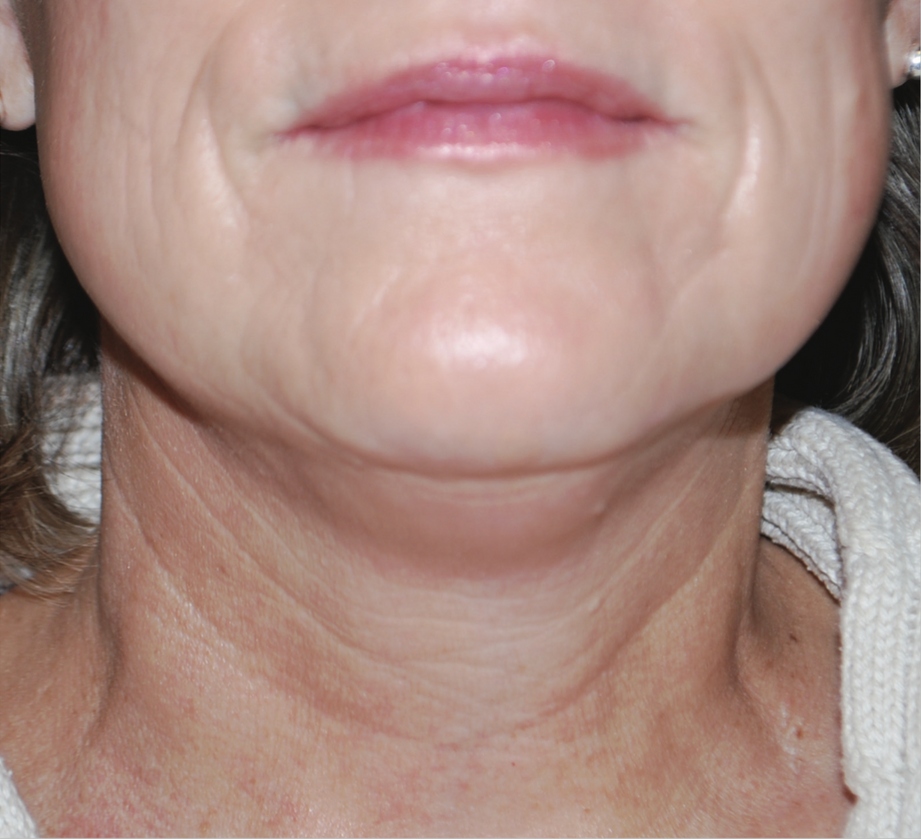 A Close Up Of A Woman's Neck And Face — Aura Mediclinic In Ashmore, QLD