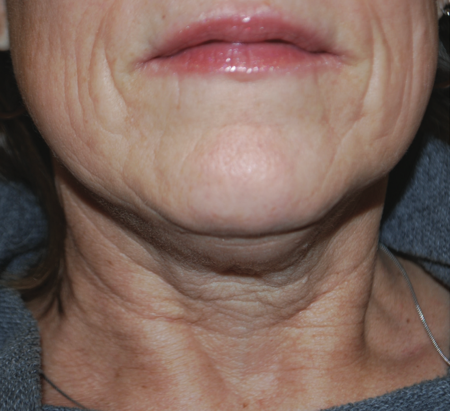 A Close Up Of An Older Woman's Neck And Face — Aura Mediclinic In Ashmore, QLD