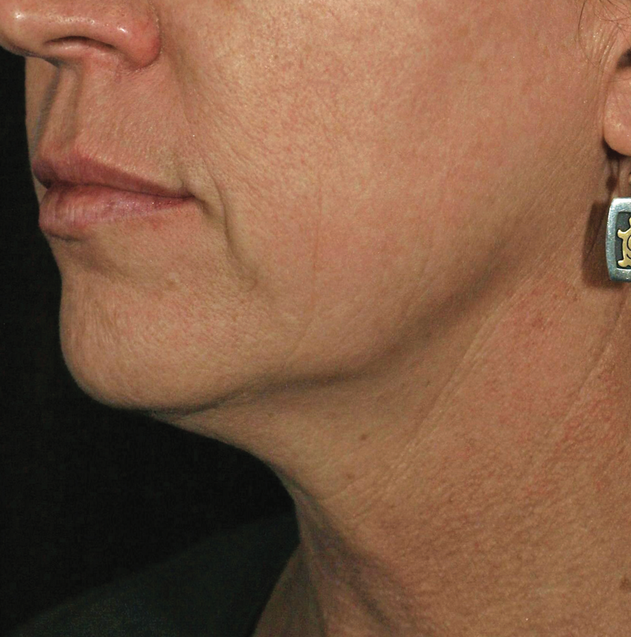 A Close Up Of A Woman's Neck And Face — Aura Mediclinic In Ashmore, QLD