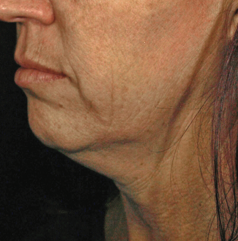 A Close Up Of An Older Woman's Neck And Face — Aura Mediclinic In Ashmore, QLD