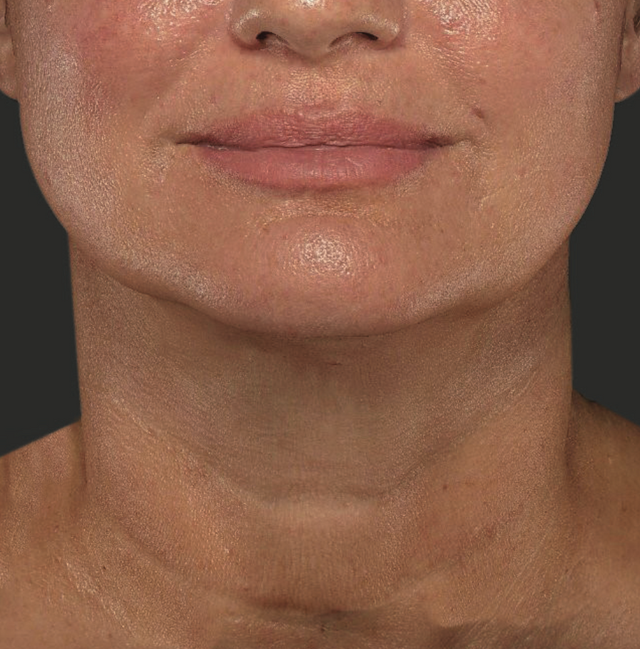 A Close Up Of A Woman's Face With He Eyes Closed — Aura Mediclinic In Ashmore, QLD