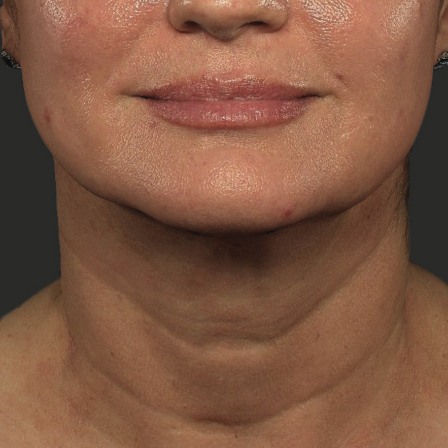 A Close Up Of A Woman's Face With Her Eyes Closed — Aura Mediclinic In Ashmore, QLD