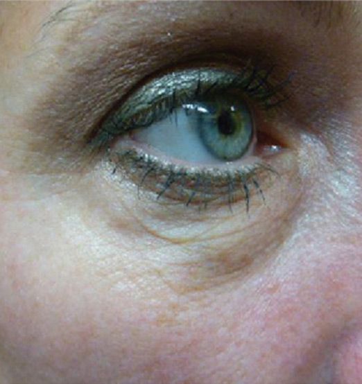 A Close Up Of A Woman's Eye With Makeup On — Aura Mediclinic In Ashmore, QLD