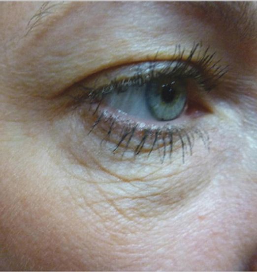 A Close Up Of A Woman's Eye With Long Eyelashes — Aura Mediclinic In Ashmore, QLD