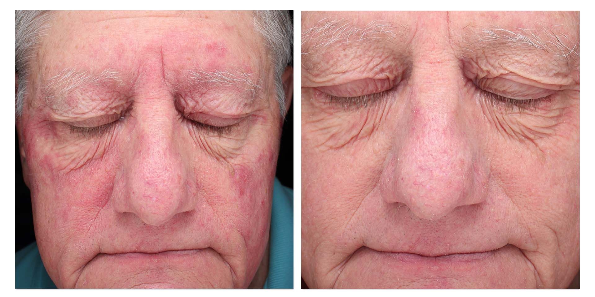 A Before And After Photo Of A Man's Face With Closed Eyes — Aura Mediclinic In Ashmore, QLD