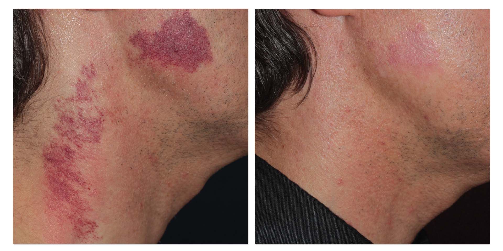 A Before And After Photo Of A Man's Neck With A Red Spot On It — Aura Mediclinic In Ashmore, QLD