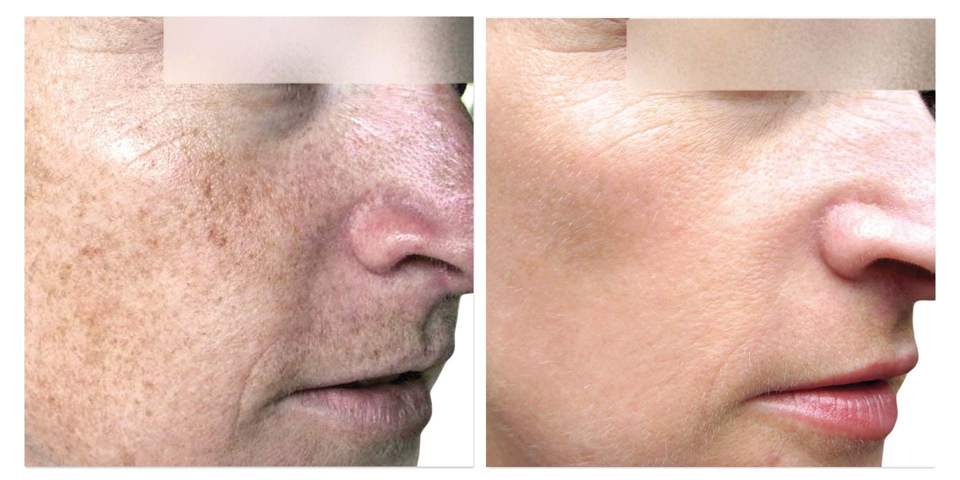 A Before And After Photo Of A Woman's Face — Aura Mediclinic In Ashmore, QLD