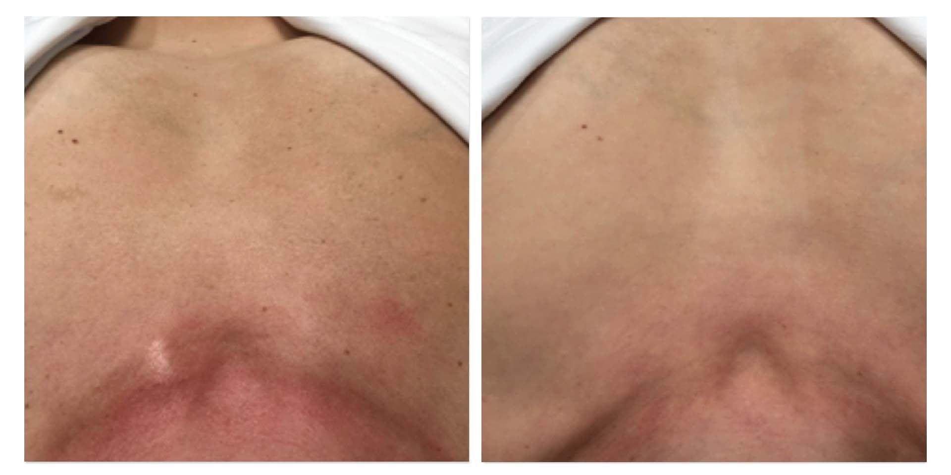 A Before And After Photo Of A Person's Chest — Aura Mediclinic In Ashmore, QLD