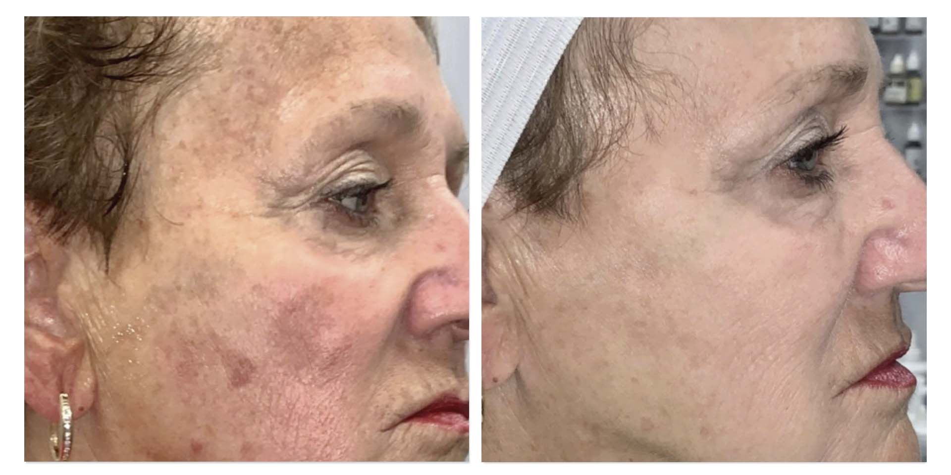 A Before And After Photo Of A Woman's Face — Aura Mediclinic In Ashmore, QLD