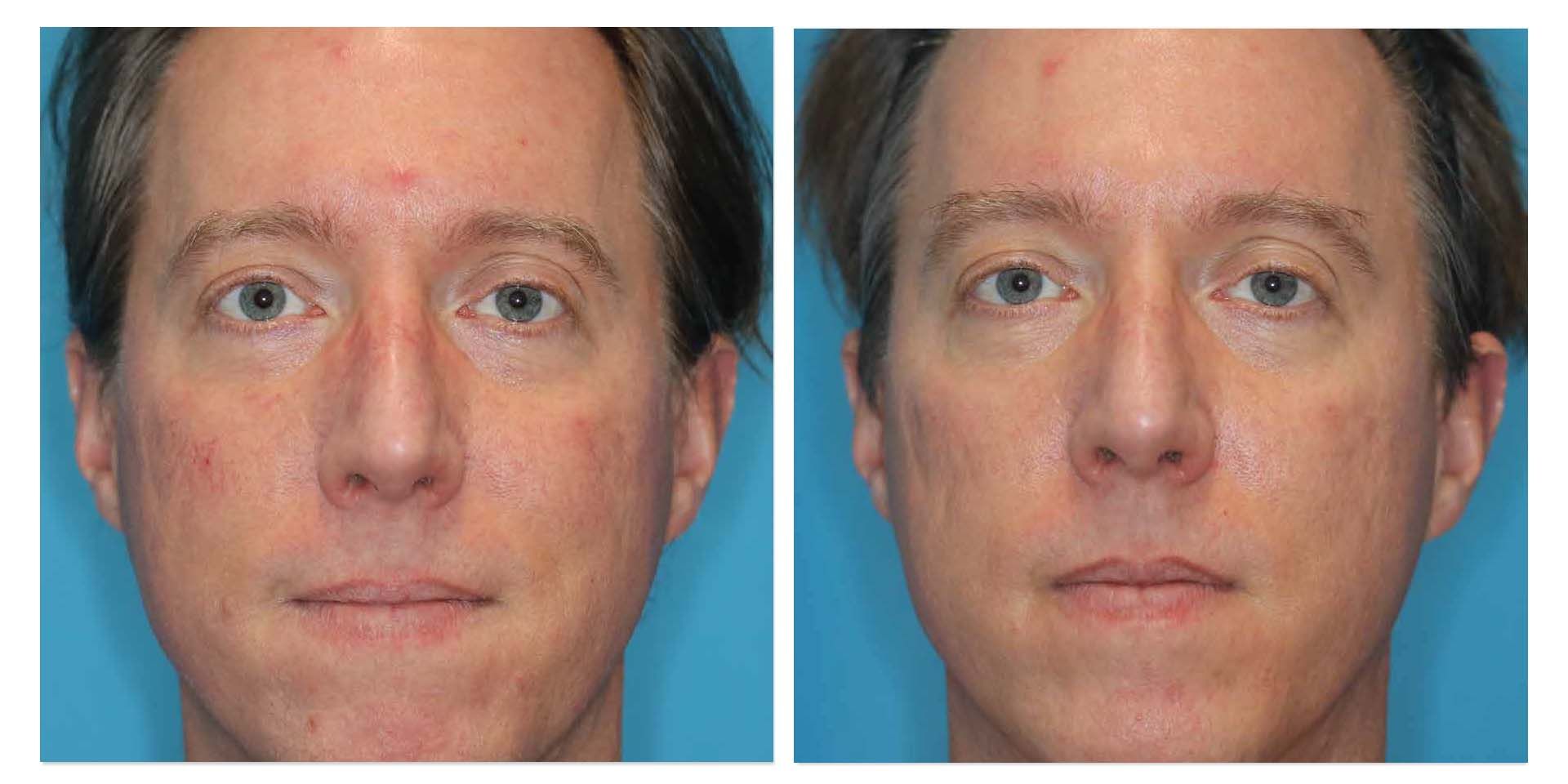 A Before And After Photo Of A Man's Face — Aura Mediclinic In Ashmore, QLD